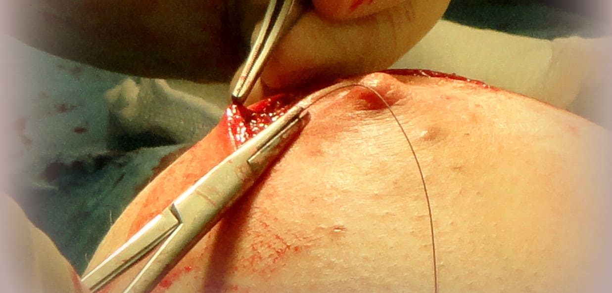 Принцип проведения процедуры под названием подтяжка груди или мастопексия
