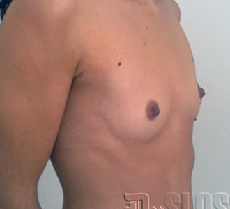 Установка имплантов  под грудной мышцей