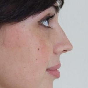 Незначна корекція спинки носа і кінчика носа