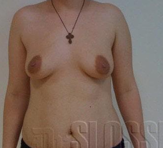 Увеличение груди имплантами МакГан объемом 315 мл