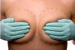 Альтернатива грудным имплантатам: пересадка жировой ткани