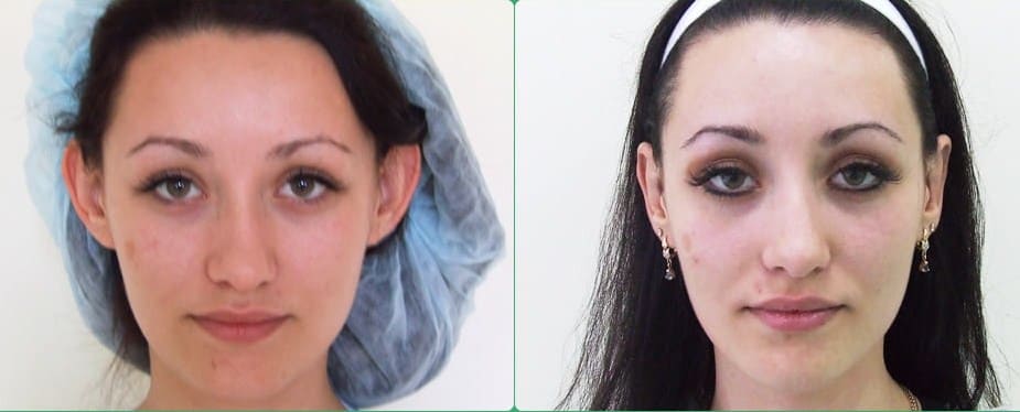 фото до и после отопластики доктора Слоссера