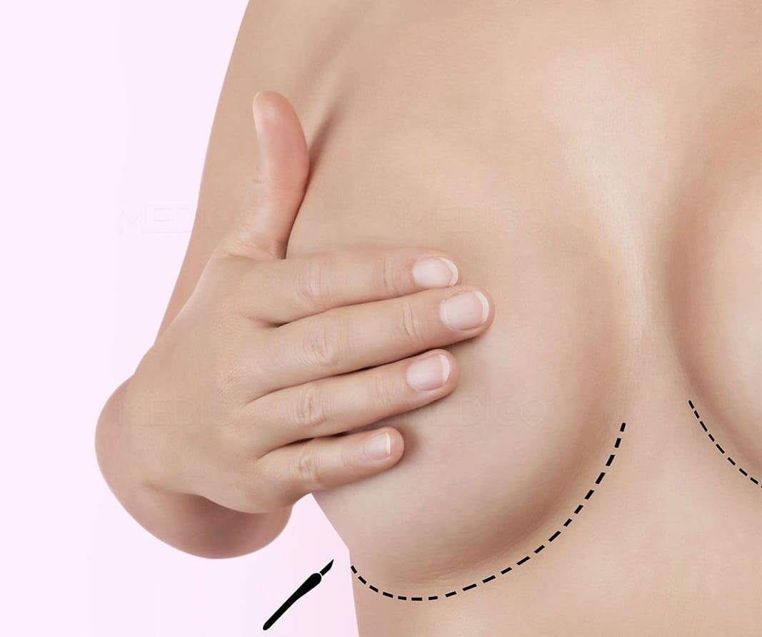 В каких случаях пациенту может понадобиться операция подтяжки груди