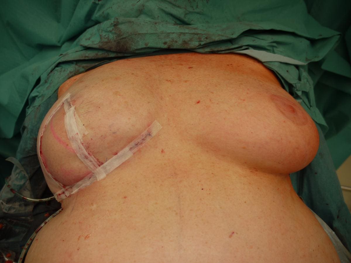 Каких результатов можно добиться с помощью операции по реконструкции груди