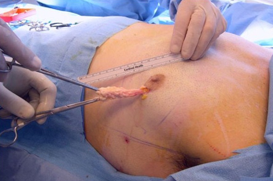 Операция гинекомастия в Киеве может быть проведена в лучшей клинике пластической хирургии