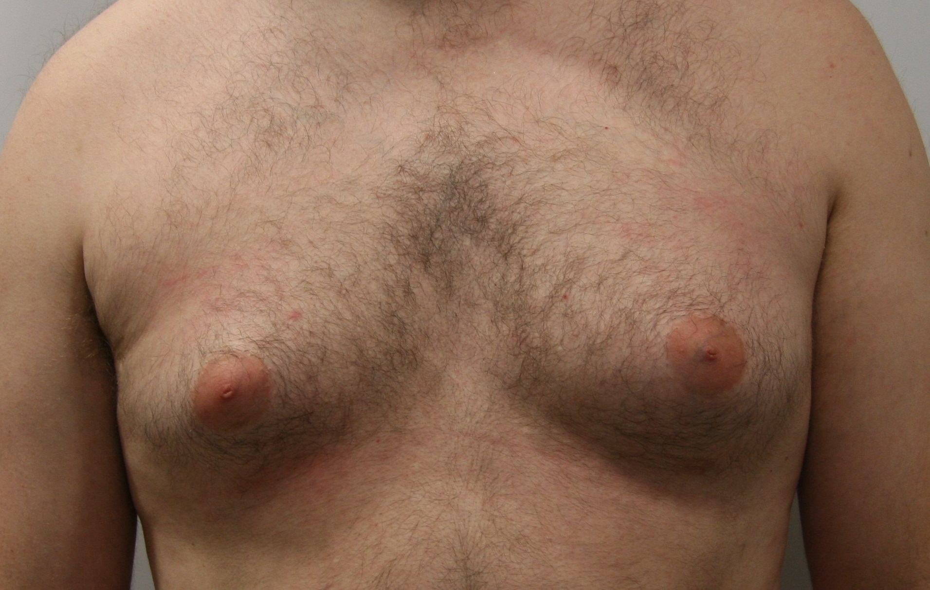 Операция гинекомастия в Киеве позволяет избавиться от большой груди мужчинам 