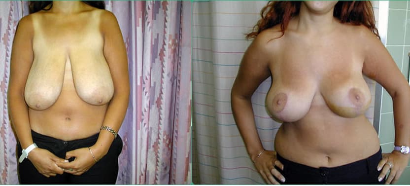 Результат проведения мастопексии или подтяжки груди в Киеве