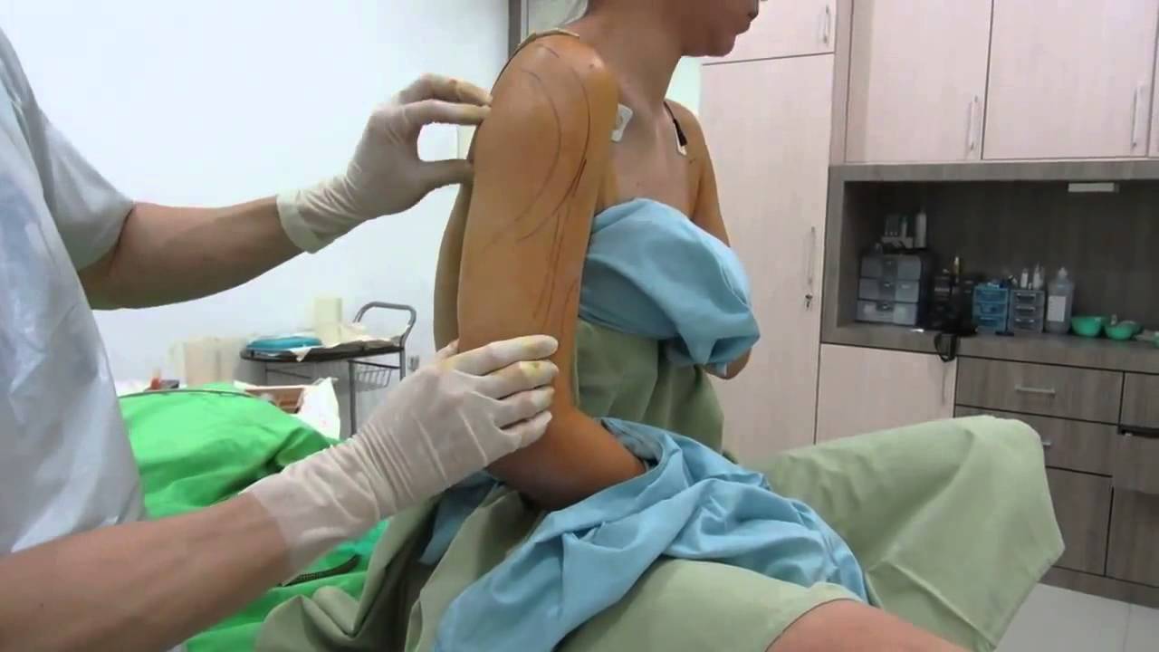 Брахиопластика в Киеве поможет избавиться от лишней кожи в области рук после липосакции