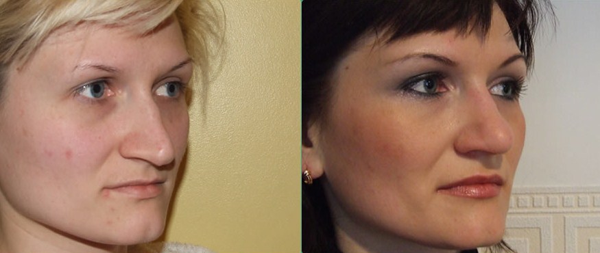 результати ринопластики носа в фото до і після