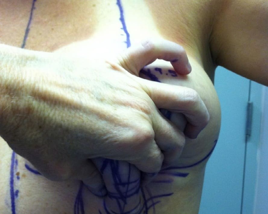 хірургічні методи підтяжки грудей
