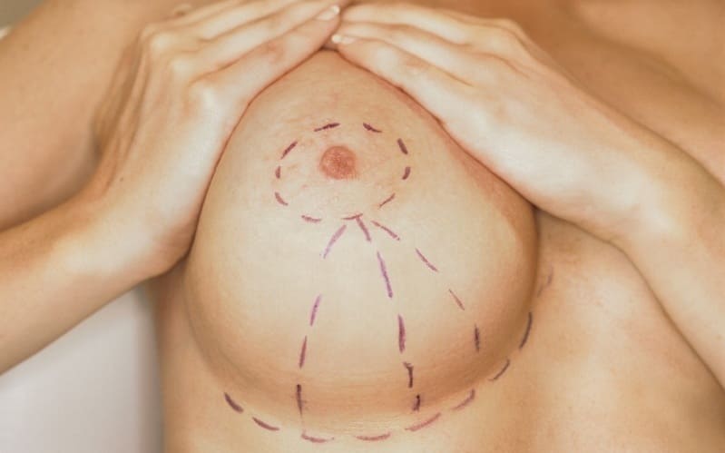 Хирургические методы уменьшения груди, как наиболее эффективный вариант решения проблем большой груди