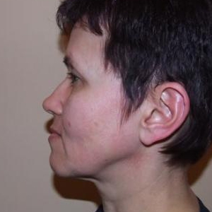 Верхняя блефаропластика и миниподтяжка лица и шеи