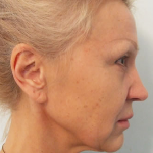 Підтяжка обличчя з використанням SMAS техніки