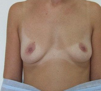 Увеличение груди имплантами МакГан объемом 225 мл
