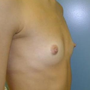 Увеличение груди имплантом МакГан объёмом 225 мл