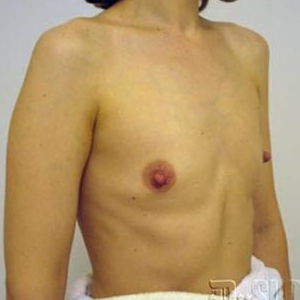Увеличение груди имплантами MacGhan 410 стиль