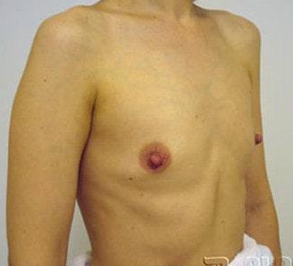 Увеличение груди имплантами MacGhan 410 стиль