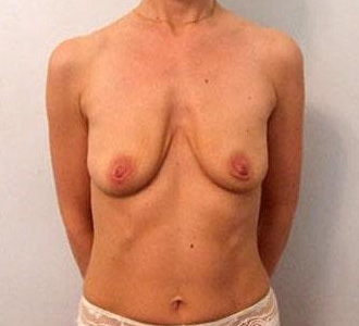 Увеличение груди с одновременной подтяжкой