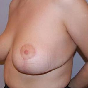 Уменьшение груди по технике Robbins