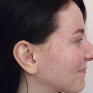 Ринопластика носа без перелому