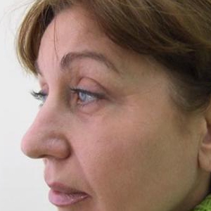 Коррекция массивного, раздвоенного кончика носа