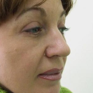 Коррекция массивного, раздвоенного кончика носа