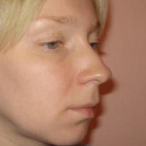 Коррекция кончика носа и ноздрей