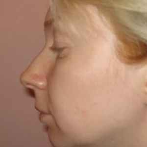 Коррекция кончика носа и ноздрей