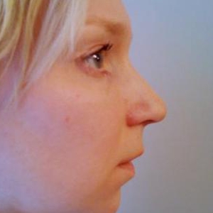 Корекція кінчика носа і ніздрів