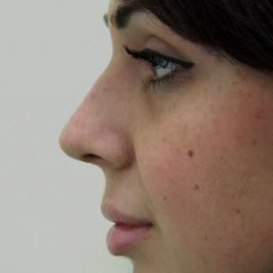 Незначительная коррекция спинки носа и кончика носа