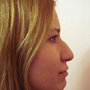 Відновлення естетичних пропорцій носа