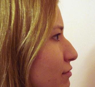 Восстановление эстетических пропорций носа