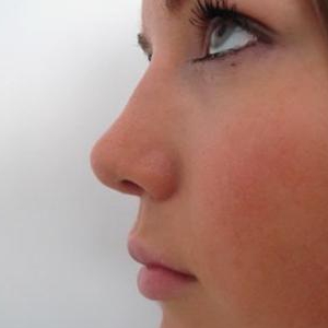 Коррекция расширенного кончика и спинки носа