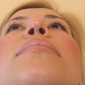 Уменьшение проекции кончика носа и коррекция левой ноздри