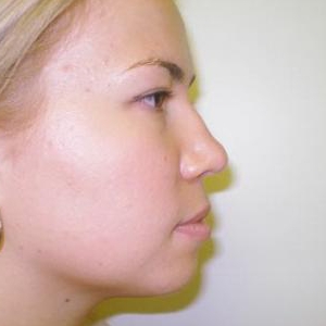 Зменшення проекції кінчика носа і корекція лівої ніздрі