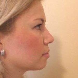 Зменшення проекції кінчика носа і корекція лівої ніздрі