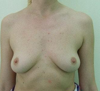 Увеличение груди круглыми имплантами МакГан
