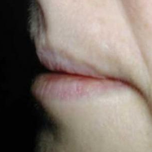 Процедура увеличения губ
