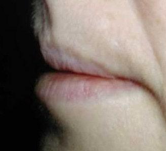 Процедура увеличения губ