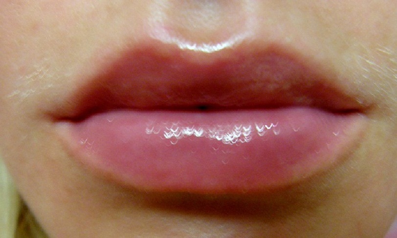 Збільшення губ