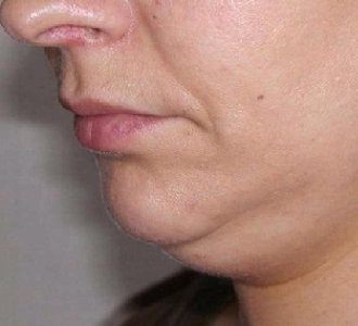 Ліпосакція підборіддя подарує чіткий овал обличчя і покращить його контури